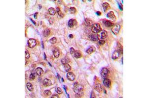 Immunohistochemical analysis of AKT staining in human lung cancer formalin fixed paraffin embedded tissue section.
