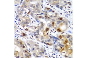 Immunohistochemistry of paraffin-embedded human gastric cancer using SUMO2 antibody (ABIN6128719, ABIN6148726, ABIN6148728 and ABIN6218594) at dilution of 1:100 (40x lens). (SUMO2 抗体  (AA 1-95))