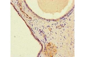 Immunohistochemistry of paraffin-embedded human prostate cancer using ABIN7175714 at dilution of 1:100 (WDFY4 抗体  (AA 1-322))