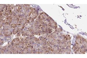 ABIN6273284 at 1/100 staining Human pancreas cancer tissue by IHC-P. (P4HA2 抗体  (Internal Region))