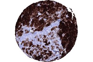 Hepatocellular carcinoma with strong FABP1 immunostaining of _95 of tumor cells (FABP1 抗体  (AA 1-127))
