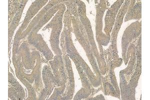 ABIN6256490 and ABIN6278656 at 1/100 staining human colon carcinoma by IHC-P.