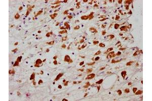 IHC image of ABIN7127713 diluted at 1:100 and staining in paraffin-embedded human melanoma cancer performed on a Leica BondTM system. (Recombinant MLKL 抗体  (pSer358))