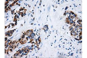Immunohistochemical staining of paraffin-embedded Adenocarcinoma of breast tissue using anti-HSD17B10 mouse monoclonal antibody.