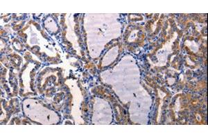 Immunohistochemistry of paraffin-embedded Human thyroid cancer using DRD1 Polyclonal Antibody at dilution of 1:50 (Dopamine Receptor d1 抗体)