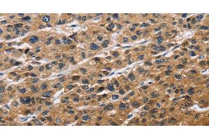 Immunohistochemistry of paraffin-embedded Human liver cancer tissue using EIF4EBP2 Polyclonal Antibody at dilution 1:40 (eIF4EBP2 抗体)