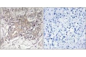 Immunohistochemistry analysis of paraffin-embedded human liver carcinoma tissue, using GCNT3 Antibody. (GCNT3 抗体  (AA 226-275))