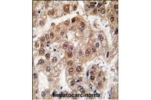 Formalin-fixed and paraffin-embedded human hepatocarcinoma tissue reacted with U2AF1 antibody (Center S70), which was peroxidase-conjugated to the secondary antibody, followed by DAB staining. (U2AF1 抗体  (AA 55-83))