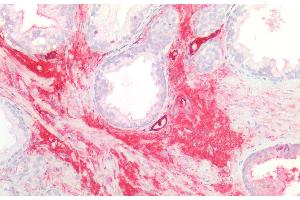 Detection of GLMP in Human Prostate Tissue using Polyclonal Antibody to Glycosylated Lysosomal Membrane Protein (GLMP) (C1orf85 抗体  (AA 246-404))