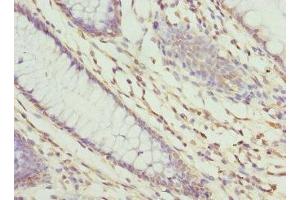 Immunohistochemistry of paraffin-embedded human colon cancer using ABIN7176235 at dilution of 1:100 (ZNF324 抗体  (AA 1-270))