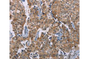 Immunohistochemistry of Human breast cancer using PLXNA4 Polyclonal Antibody at dilution of 1:50 (Plexin A4 抗体)