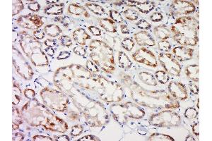 Formalin-fixed and paraffin embedded human kidney cancer labeled with CBY1 Polyclonal Antibody, Unconjugated  at 1:200 followed by conjugation to the secondary antibody and DAB staining (CBY1/PGEA1 抗体  (AA 51-126))