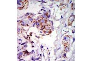 Formalin-fixed and paraffin-embedded human cancer tissue reacted with the primary antibody, which was peroxidase-conjugated to the secondary antibody, followed by DAB staining. (GRK6 抗体  (C-Term))