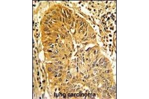 Formalin-fixed and paraffin-embedded human lung carcinoma with CALD1 Antibody (Center), which was peroxidase-conjugated to the secondary antibody, followed by DAB staining. (Caldesmon 抗体  (AA 428-457))