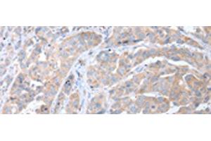 Immunohistochemistry of paraffin-embedded Human breast cancer tissue using ATG16L1 Polyclonal Antibody at dilution of 1:40(x200) (ATG16L1 抗体)