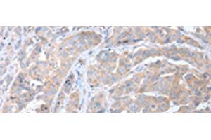 Immunohistochemistry of paraffin-embedded Human breast cancer tissue using ATG16L1 Polyclonal Antibody at dilution of 1:40(x200)