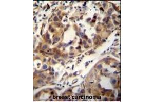 CCDC17 antibody (C-term) (ABIN654991 and ABIN2844627) immunohistochemistry analysis in formalin fixed and paraffin embedded human breast carcinoma followed by peroxidase conjugation of the secondary antibody and DAB staining. (CCDC17 抗体  (C-Term))