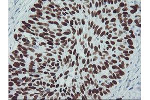 Immunohistochemical staining of paraffin-embedded Carcinoma of Human lung tissue using anti-TP53 mouse monoclonal antibody. (p53 抗体)