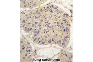 Formalin-fixed and paraffin-embedded human lung carcinoma tissue reacted with FKBP12 antibody (Center) (ABIN392172 and ABIN2841886) , which was peroxidase-conjugated to the secondary antibody, followed by DAB staining. (FKBP1A 抗体  (AA 43-74))