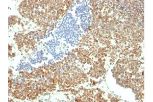 Formalin-fixed, paraffin-embedded human Colon Carcinoma stained with BMI1 Mouse Monoclonal Antibody (BMI1/2690).
