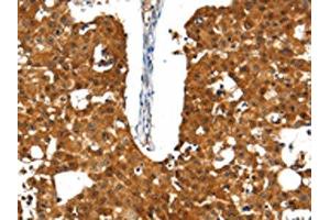 The image on the left is immunohistochemistry of paraffin-embedded Human breast cancer tissue using ABIN7192661(SSTR5 Antibody) at dilution 1/30, on the right is treated with synthetic peptide. (SSTR5 抗体)