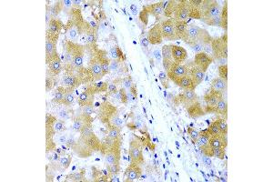 Immunohistochemistry of paraffin-embedded human liver cancer using TIRAP antibody at dilution of 1:200 (40x lens). (TIRAP 抗体)