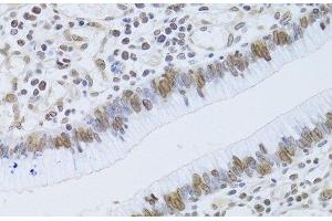 Immunohistochemistry of paraffin-embedded Human gastric cancer using LMNB2 Polyclonal Antibody at dilution of 1:100 (40x lens). (Lamin B2 抗体)