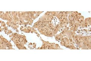 Immunohistochemistry of paraffin-embedded Human liver cancer tissue using ZNF24 Polyclonal Antibody at dilution of 1:35(x200) (ZNF24 抗体)