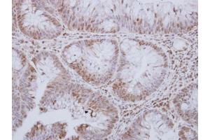 IHC-P Image STK24 antibody [N2C1], Internal detects STK24 protein at cytosol and nucleus on human breast carcinoma by immunohistochemical analysis. (STK24 抗体)