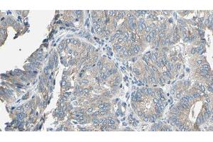 ABIN6277142 at 1/100 staining Human cervical cancer tissue by IHC-P. (CYP2E1 抗体  (Internal Region))