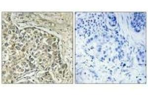 Immunohistochemistry analysis of paraffin-embedded human lung carcinoma tissue using ARSD antibody. (Arylsulfatase D 抗体)