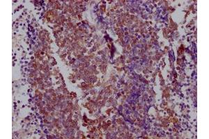 IHC image of ABIN7127859 diluted at 1:100 and staining in paraffin-embedded human lung cancer performed on a Leica BondTM system. (Recombinant NKX2-1 抗体)
