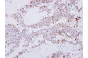 IHC-P Image Immunohistochemical analysis of paraffin-embedded human colon carcinoma, using GRAP2, antibody at 1:500 dilution. (GRAP2 抗体)