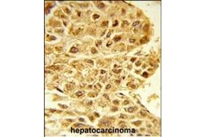 Formalin-fixed and paraffin-embedded human hepatocarcinoma reacted with E2F5 Antibody (N-term), which was peroxidase-conjugated to the secondary antibody, followed by DAB staining. (E2F5 抗体  (N-Term))