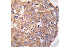 Formalin-fixed and paraffin-embedded human breast carcinoma tissue reacted with SNK Antibody (C-term ) , which was peroxidase-conjugated to the secondary antibody, followed by DAB staining. (PLK2 抗体  (C-Term))