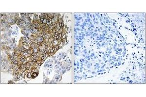 Immunohistochemistry analysis of paraffin-embedded human lung carcinoma tissue, using GJA3 Antibody. (GJA3 抗体  (AA 151-200))