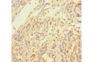 Immunohistochemistry of paraffin-embedded human pancreatic cancer using ABIN7173968 at dilution of 1:100 (INPP4B 抗体  (AA 1-53))