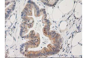 Immunohistochemical staining of paraffin-embedded Adenocarcinoma of Human colon tissue using anti-PLEKHA3 mouse monoclonal antibody. (PLEKHA3 抗体)