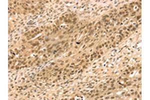 The image on the left is immunohistochemistry of paraffin-embedded Human breast cancer tissue using ABIN7131203(STAG2 Antibody) at dilution 1/35, on the right is treated with fusion protein. (STAG2 抗体)
