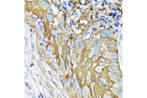 Immunohistochemistry of paraffin-embedded human lung squamous carcinoma tissue using Involucrin Rabbit mAb (ABIN6128025, ABIN6141815, ABIN6141818 and ABIN7101419) at dilution of 1:100 (40x lens). (Involucrin 抗体)