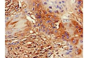 Immunohistochemistry of paraffin-embedded human cervical cancer using ABIN7164355 at dilution of 1:100 (DDX4 抗体  (AA 1-223))