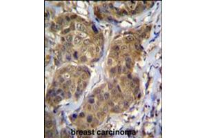 RNF11 Antibody immunohistochemistry analysis in formalin fixed and paraffin embedded human breast carcinoma followed by peroxidase conjugation of the secondary antibody and DAB staining. (RNF11 抗体  (AA 64-90))