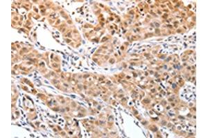 The image on the left is immunohistochemistry of paraffin-embedded Human lung cancer tissue using ABIN7129251(DPPA2 Antibody) at dilution 1/30, on the right is treated with fusion protein. (DPPA2 抗体)