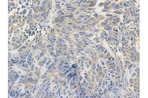 C1orf43 Antibody at 1/100 staining human lung squamous cell carcinoma by IHC-P. (C1orf43 抗体)