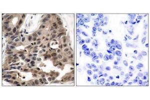 Immunohistochemical analysis of paraffin-embedded human breast carcinoma tissue using 4E-BP1 (Ab-36) antibody (E021215). (eIF4EBP1 抗体)