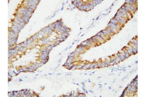 Anti-BCAT2 antibody, IHC(P) IHC(P): Human Colon Cancer Tissue (BCAT2 抗体  (C-Term))