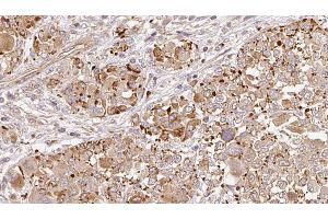 ABIN6269006 at 1/100 staining Human melanoma tissue by IHC-P. (Metabotropic Glutamate Receptor 6 抗体  (C-Term))