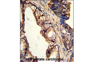 Formalin-fixed and paraffin-embedded human prostate carcinoma with TGM4 Antibody , which was peroxidase-conjugated to the secondary antibody, followed by DAB staining. (TGM4 抗体  (AA 135-164))