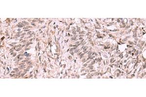 Immunohistochemistry of paraffin-embedded Human ovarian cancer tissue using KDM7A Polyclonal Antibody at dilution of 1:35(x200) (JHDM1D 抗体)