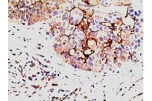 EPS8 polyclonal antibody (Cat # PAB6473, 5 ug/mL) staining of paraffin embedded human breast Carcinoma. (EPS8 抗体)